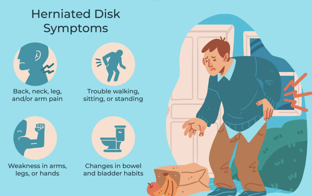 intervertebral disk herniation